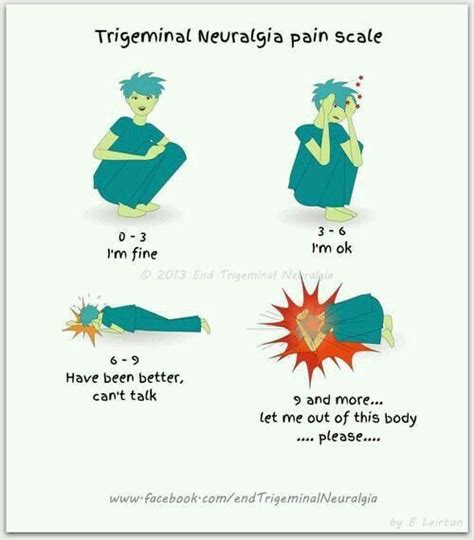 tgn no|trigeminal neuralgia pain chart.